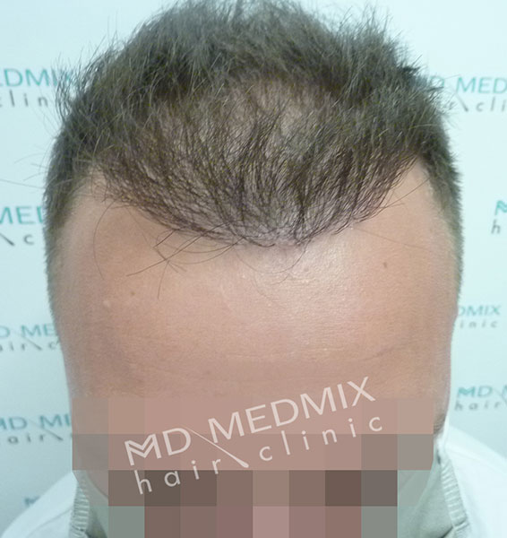 nadmierne wypadanie włosów