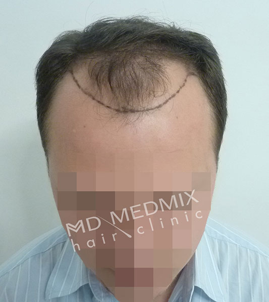 Wypadanie włosów leczenie